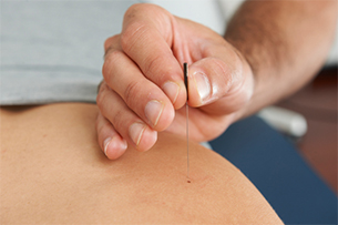 ddry needling